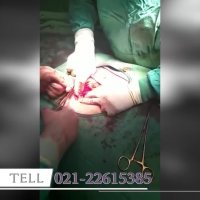 عمل هیسترکتومی یا برداشتن رحم