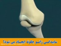 علت ایجاد ساییدگی زانو