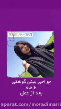 نمونه کار جراحی زیبایی بینی