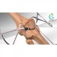 ترمیم شکستگی کشکک