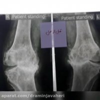 عملیه استبدال المفصل الرکبتین