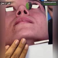 جراحی بینی ترمیمی | دکتر باستانی نژاد بهترین جراح بینی ترمیمی تهران