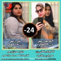 24 کیلوگرم کاهش وزن 4 ماه بعد از بای پس کلاسیک
