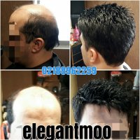 ترمیم موی الگانت /02188962259/پروتز مو