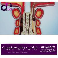 جراحی درمان سینوزیت