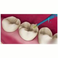 فیلم کامل ترمیم دندان