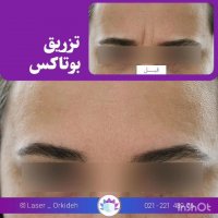 تزریق بوتاکس در کلینیک ارکیده