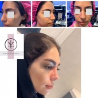 رضایت بیمار از نتیجه جراحی بینی 3 ماه بعد از عمل