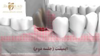 ایمپلنت دندان در جلسه دوم