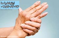 روماتیسم مفصلی با آرتریت روماتوئید