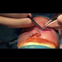 عمل پلک پایین در یک کودک | پروفسور کشکولی | جراح پلک تهران