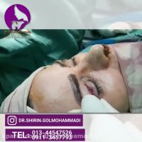 فیلم جراحی بلفاروپلاستی