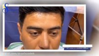 فیلمی از نتیجه جراحی زیبایی بینی بلافاصله پس از برداشتن قوز بینی