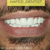 فیلم تعویض روکش دندان جلویی و کامپوزیت