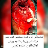 شکستگی خرد شده دیستال هومروس