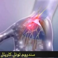 سندرم تونل کارپال