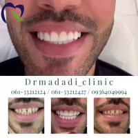 ونیر کامپوزیت فک بالا و پایین