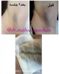 رفع تیرگی زیر بغل با کربوکسی تراپی