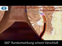 بهترین درمان برای فیستول مقعدی در کلینیک ونک لیزر https://vanaklaser.ir/