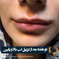 تزریق ژل لب