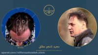 مجید نامجو مطلق قبل و بعد از کاشت مو در کلینیک دکتر نیلفروش زاده