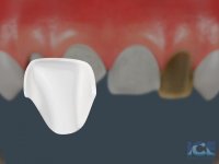 درمان لمینیت به صورت انیمیشن|کلینیک مدرن