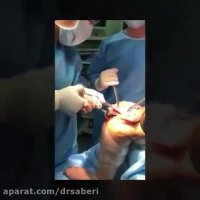 عمل تعویض مفصل زانو