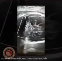 فیلم سونوگرافی مغز جنین