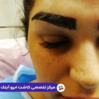 کاشت ابرو انجام شده | کلینیک آیتک | 44228594-021