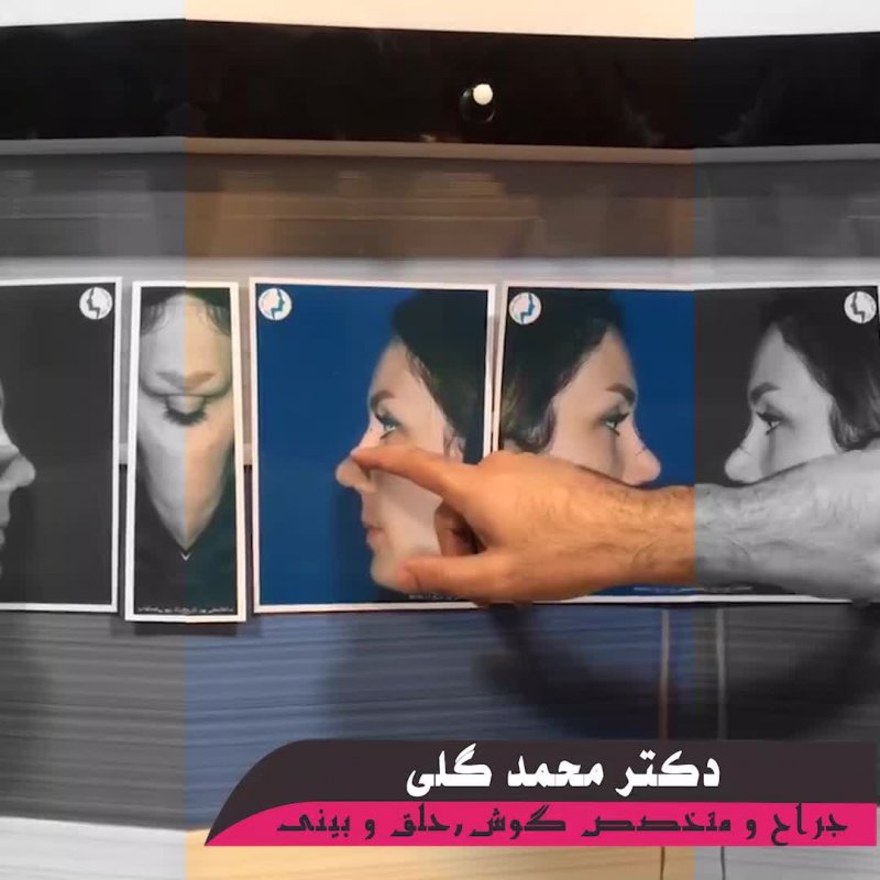 بلافاصله پس از جراحی ترمیمی بینی | بهترین جراح بینی تهران