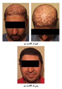 کاشت مو در اسکار