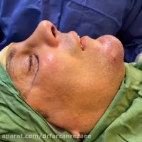 فیلم بعد از عمل بینی و تزریق چربی به چانه و زیرچشم