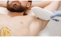 لیزر موهای زائد آقایان