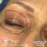 فیلم بلفاروپلاستى پلك فوقانى و تحتانى