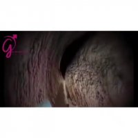 جراحی اندوسکوپی پروستات