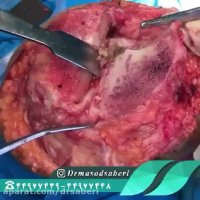 ساییدگی شدید سمت داخلی زانو به علت آرتروز شدید