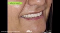 لامینیت سرامیکی ۸ دندان جلویی فک بالا توسط متخصص پروتز های دندانی و زیبایی