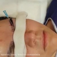 زیبایی چهره با کاشت ابرو