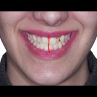 ارتودنسی جلو بودن فک پایین بدون جراحی فک | دکتر داودیان