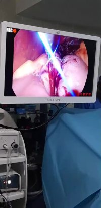 لایو اینستاگرام : جراحی چاقی بای پس کلاسیک خانم  33 ساله