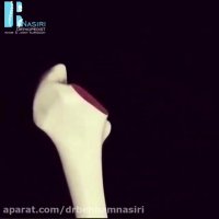 فیلم مراحل جراحی تعویض مفصل لگن