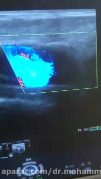 سونوگرافی کالر داپلر عروق گردن