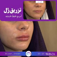 تزریق ژل لب و خط خنده در کلینیک ارکیده
