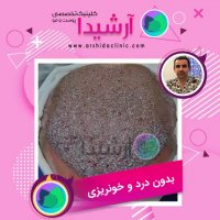 کاشت مو با تراکم بالا