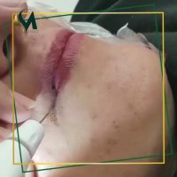 رفع چین و چروک اطراف لب با پلکسر