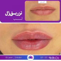 تزریق ژل لب در کلینیک ارکیده