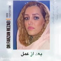 نمونه جراحی بینی طبیعی 2 سال بعد از عمل