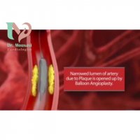 فیلم آنژیوپلاستی قلب