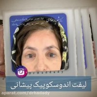 فیلم لیفت اندوسکوپیک پیشانی