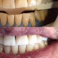 بلیچینگ دندان